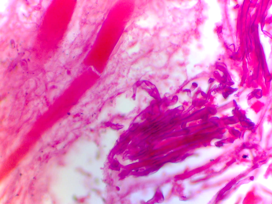 Broad, aseptate hyphae of mucormycosis with muscle and fat invasion, H&E stain 400X