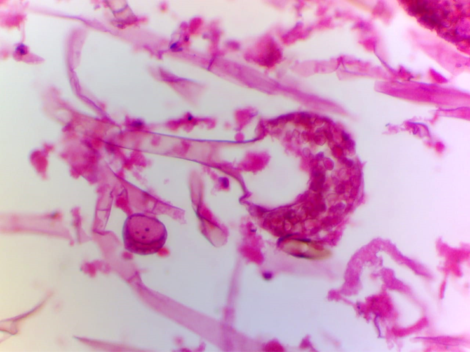Photomicrograph shows broad fungal hyphae exhibiting ovoid mature sporangia, H&E stain 400X