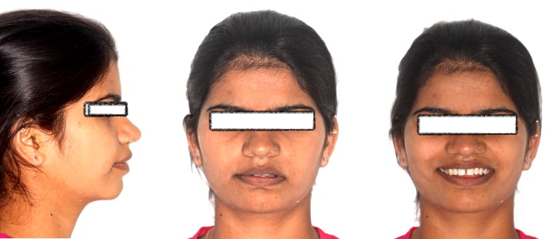 Pre-treatment extra-oral photographs