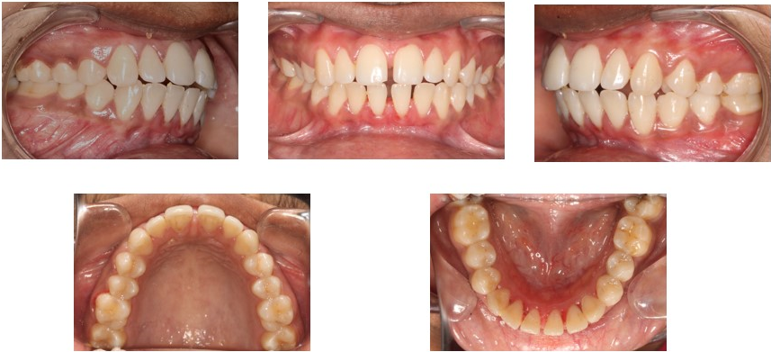 Pre-treatment intra-oral photographs