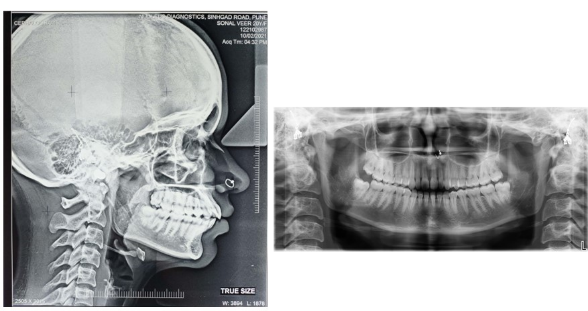 Pre-treatment orthopantomogram and lateral cephalogram.