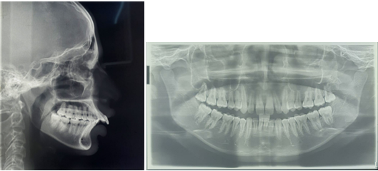 Pre- treatment lateral cephalogram and OPG