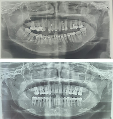 Mid and post treatment OPG