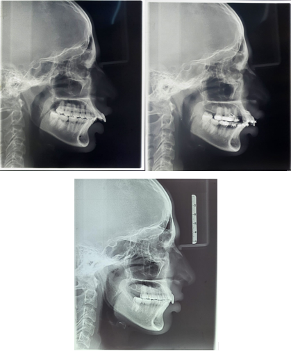 Lateral cephalograms of pre, mid and post treatment