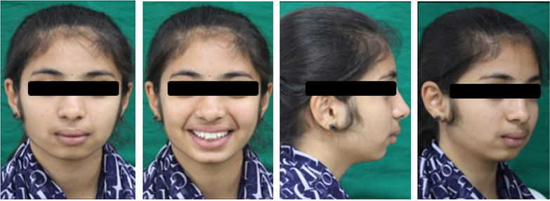 Pre-treatment intraoral photogrphs