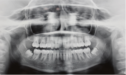 Post- treatment OPG