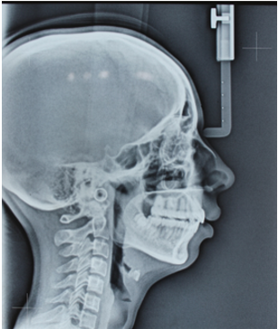 Post- treatment lateral cephalogram