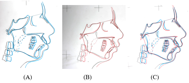 Superimposition of pre-treatment (black), mid- treatment (blue) (a) post-treatment (red) (b), comparison of pre, mid and post treatment cephalometric landmarks (c).