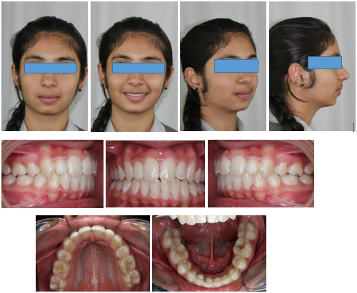 One year post retention extra-oral and intraoral photographs