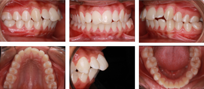 Pre-treatment intraoral photographs