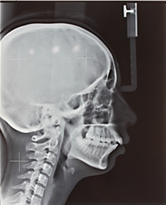 Pre-treatment lateralcephalogram