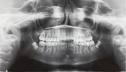 Pre- treatment OPG