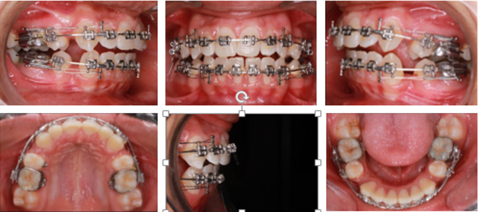 En –masse retraction of anterior segment