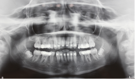 Mid– treatment OPG