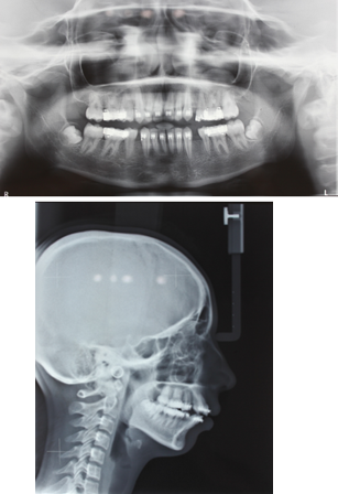 Mid treatment lateralcephalogram