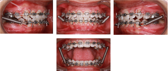 Initiation of forsus fixed functional appliance therapy
