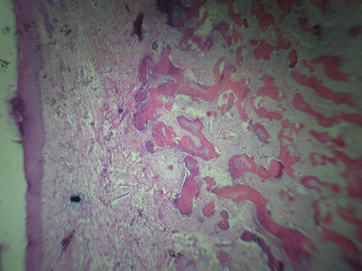 Histological examination of excised tissue