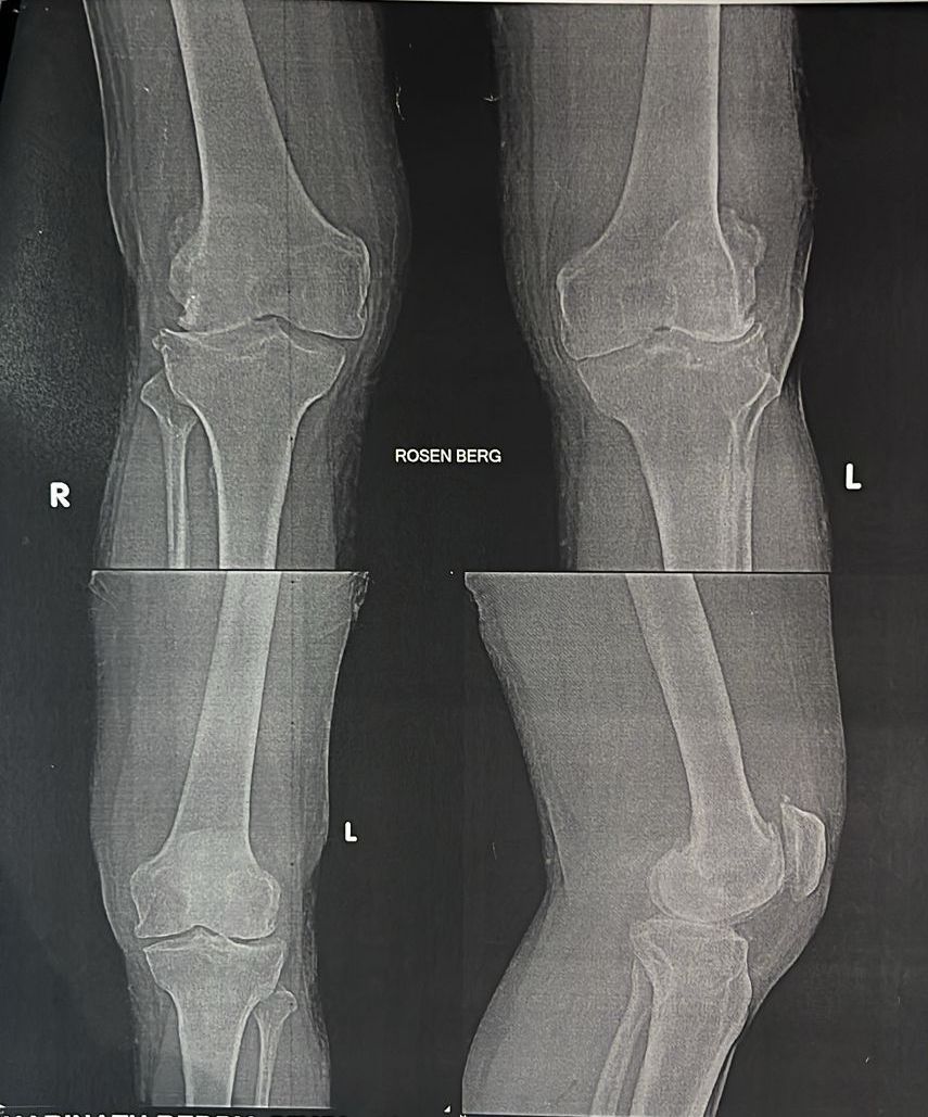 A 55-year-old male patient showing decreased lateral tibio-femoral joint space as compared with standard weight bearing AP view. The severity of KL & Ahlback scores changed from previous grade I on AP view to grade III on Rosenberg view