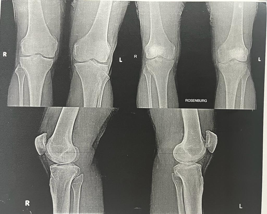 A 45-year-old male patient showing decreased medial tibio-femoral joint space as compared with standard weight bearing AP view. The severity of KL & Ahlback scores changed from previous grade I on AP view to grade III on Rosenberg view.