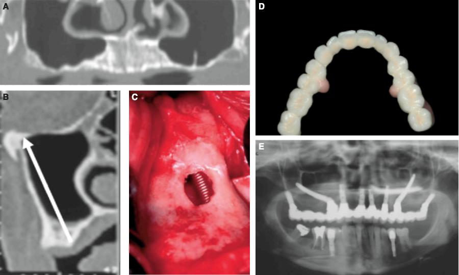 Clinical photograph showing a lateral window of the maxillary sinus for visual control of implant insertion