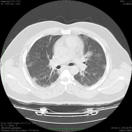 35-year-old male presented fever and cough with RT-PCR positive. Multiple patchy areas of ground glass opacities are noted in the bilateral lung predominantly subpleural location