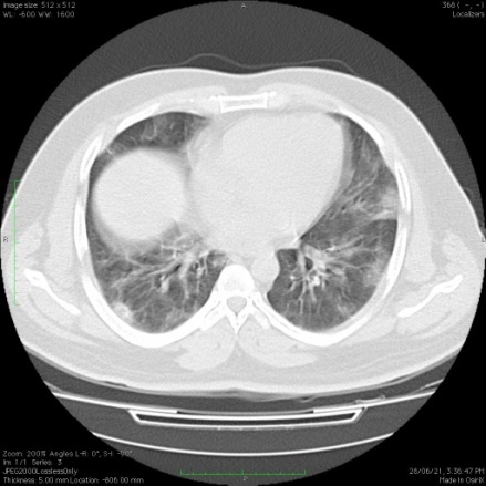 43-year-old patient presents with fever, breath lessness, and cough. RT-PCR was positive. Multiple patchy areas of ground glass opacities are noted in the bilateral lung predominantly subpleural location