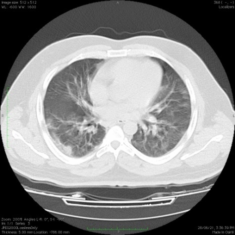 28-year-old patient presented with breathlessness with RT-PCR negative. Multiple patchy areas of Ground glass opacities are noted in the bilateral lung predominantly subpleural location