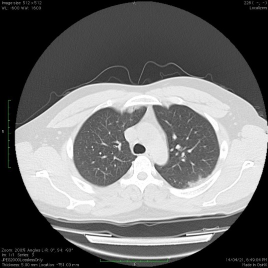 18-year-old male patient presented with cough and fever with RT-PCR negative. Multiple patchy areas of Ground glass opacities are noted in the bilateral lung predominantly subpleural location