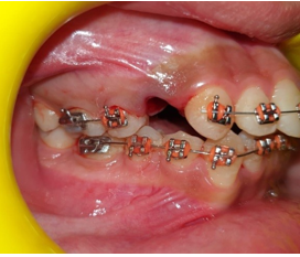 Immediate post-atraumatic extraction photograph.