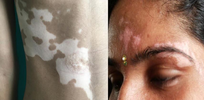 Segmental vitiligo