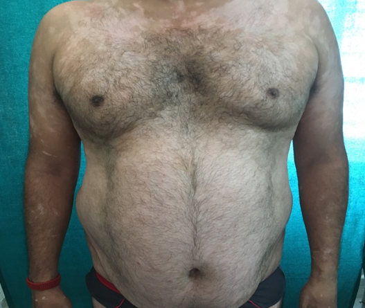 Vitiligo vulgaris