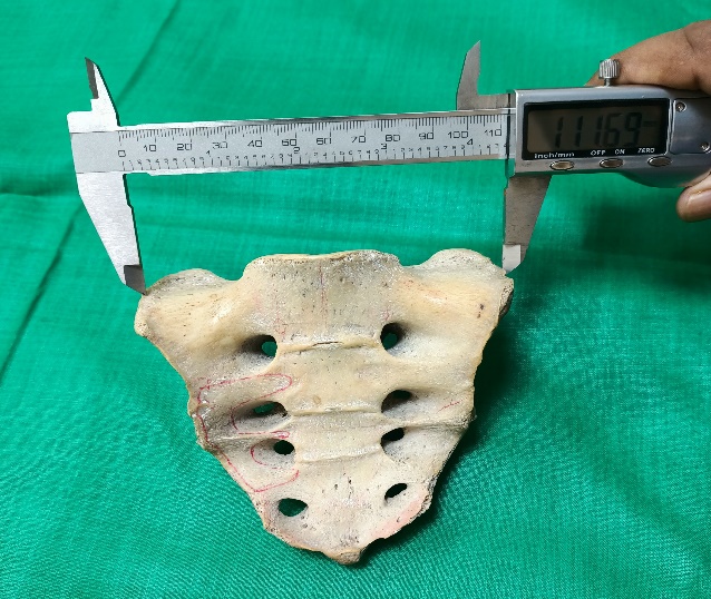 Showing maximum breadth of sacrum