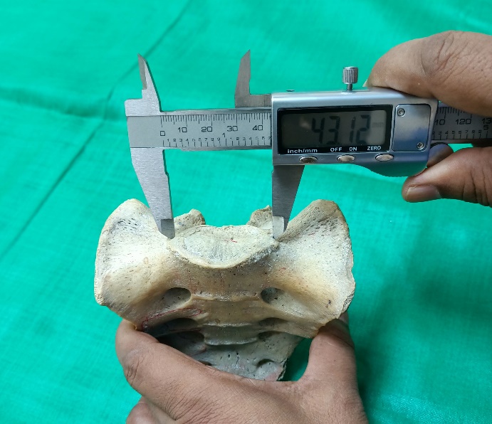 Showing maximum transverse diameter of body of 1st sacral vertebra