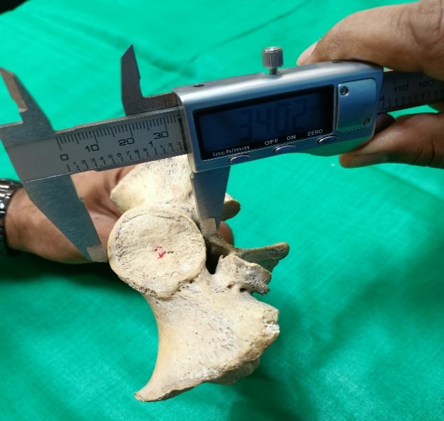 Showing maximum antero-posterior diameter of 1st sacral vertebra