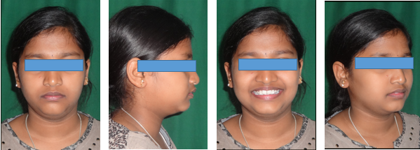 Pre-treatment extraoral