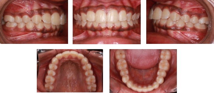 Two year post-retention intraoral