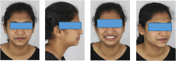 Two year post-retention Extraoral