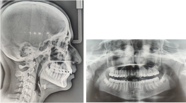 Two year post-retention lateal cephalogram and OPG