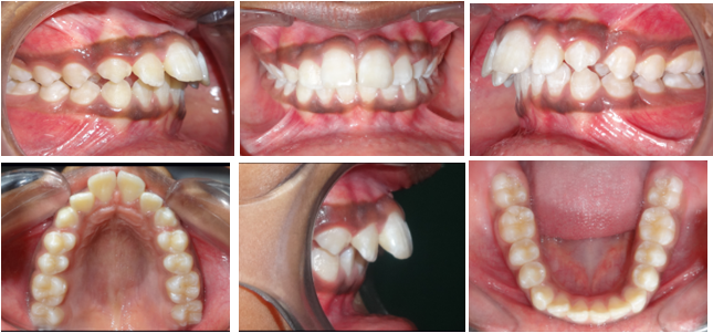 Pre-treatment intraoral