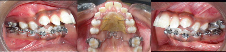 Mid-treatment - Post distalization