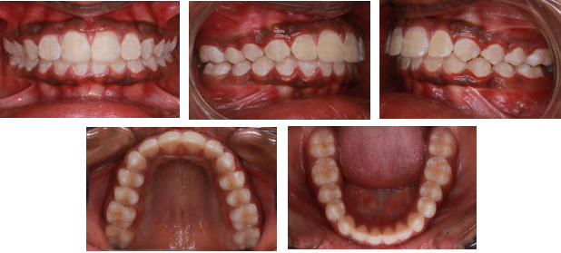 Post-treatment Intraoral