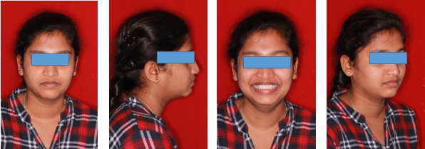 Post-treatment extraoral