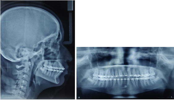 Post-treatment lateral cephalogram and OPG