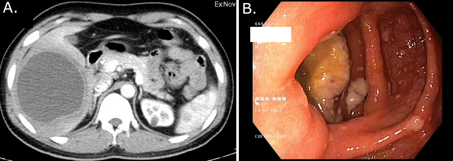 A. Colonoscopy picture showing the cecal ameboma; B. Typical appearance of a liver abscess on contrast CT (water density mass with a low attenuation rim, a pigtail cat).