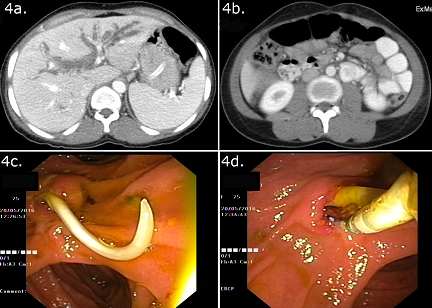 Biliary ascariasis in a 24-year-old female patient. 4a. Contrast CT abdomen showing the dilatation of intrahepatic biliary ducts. 4b. Worms in the duodenum as viewed end on. c) A worm protruding out of the ampulla at ERCP. d) Removal of worms with balloon sweep and grasping forceps.