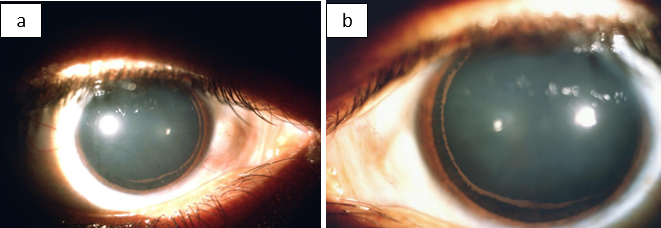 a: Scheie stripe or Zentmayer’s ring in right eye; b: Scheie stripe or Zentmayer’s ring in left eye.