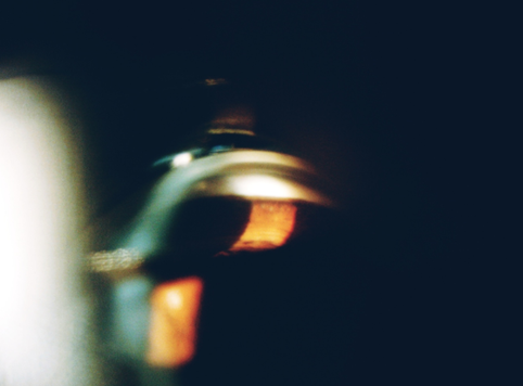 Hyperpigmented trabecular meshwork with concave iris configuration on gonioscopy