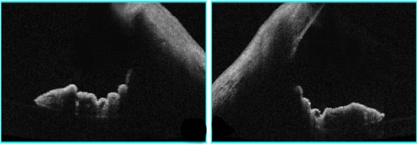 Concave iris configuration onAnterior segment optical coherence tomography.