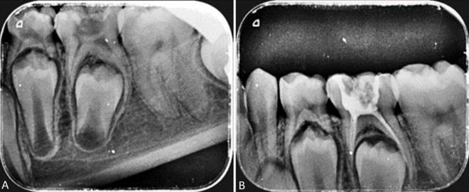 Preoperative and postoperative radiographs of lower second primary molar filled with incremental technique; A: Preoperative radiograph; B: Postoperative radiograph