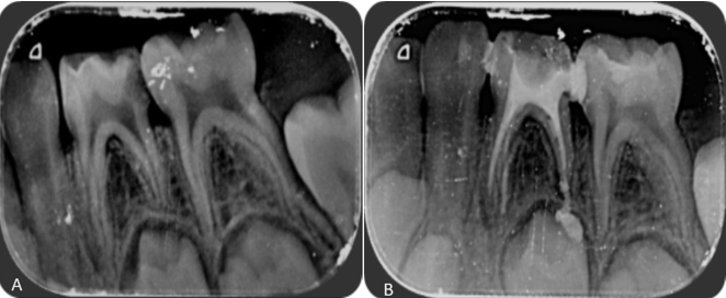 Preoperative and postoperative radiographs of lower first primary molar filled withslow-speed motor-driven lentulo-spiral technique. A: Preoperative radiograph; B: Postoperative radiograph